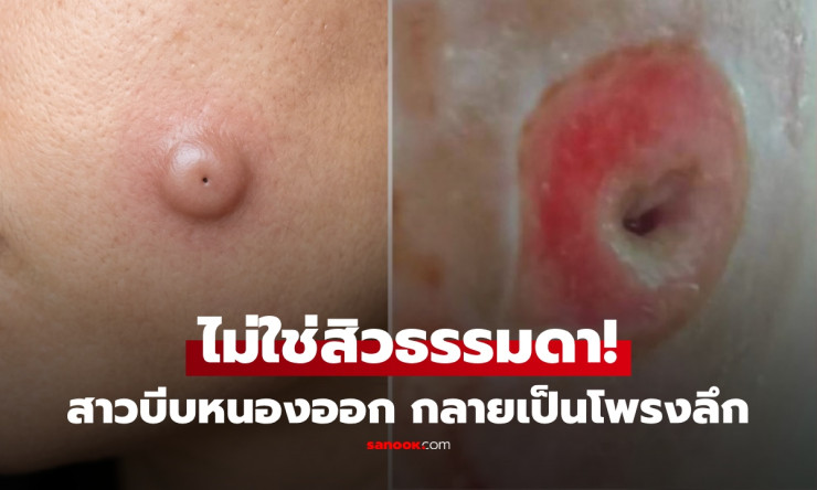 สาวเจอตุ่มบนแก้มคิดว่าเป็นสิว บีบเองแทบช็อก! สุดท้ายกลายเป็นโพรงลึก ลามติดเชื้อหนัก หมอเตือนนี่อาจไม