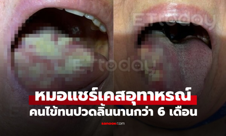 ปวดลิ้นนิดเดียวกลายมะเร็งกินครึ่งลิ้น! เผยอุทาหรณ์หญิงใจกล้าทน 6 เดือน สุดท้ายกลิ่นเน่าโชยคลุ้ง ใจหม