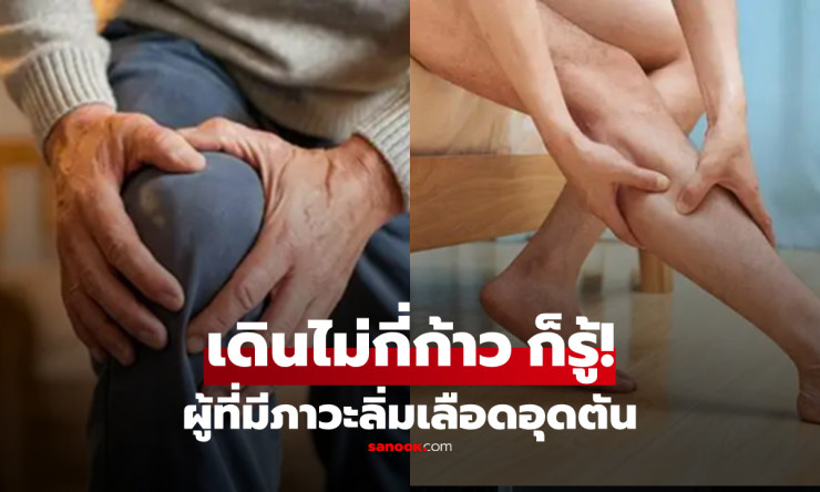 รู้ไว้ดีกว่า! สัญญาณเตือนภาวะลิ่มเลือดอุดตัน ขณะเดินที่หลายคนมองข้าม