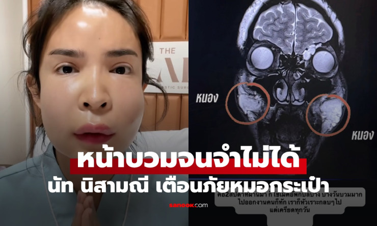 บวมจนจำไม่ได้! นัท นิสามณี เตือนภัยฉีดหน้าหมอกระเป๋า ระเบิดเวลา 10 ปีเพิ่งปะทุ