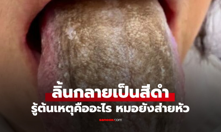 ขนลุกสุดขีด! ลิ้นกลายเป็นป่าดำขนยาว หลังกินข้าวเสร็จแค่นี้ทุกวัน หมอเห็นยังแทบเป็นลม